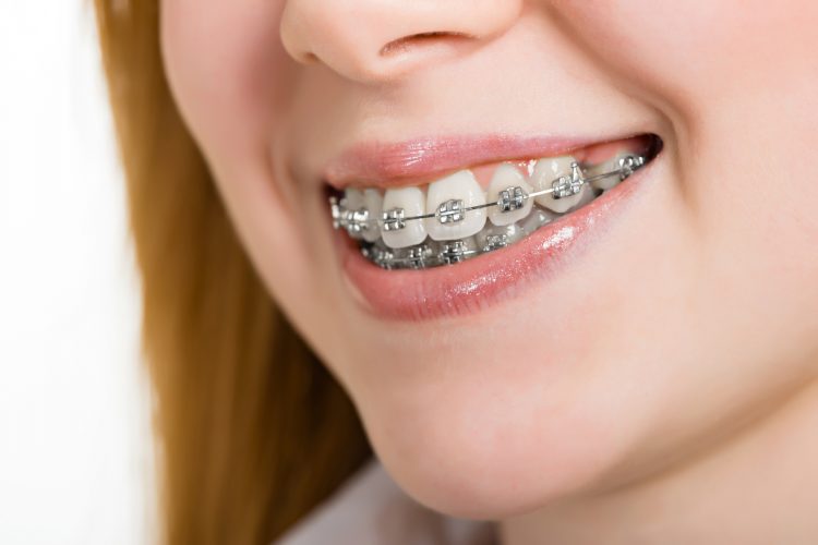 braces in dental lounge bahria town