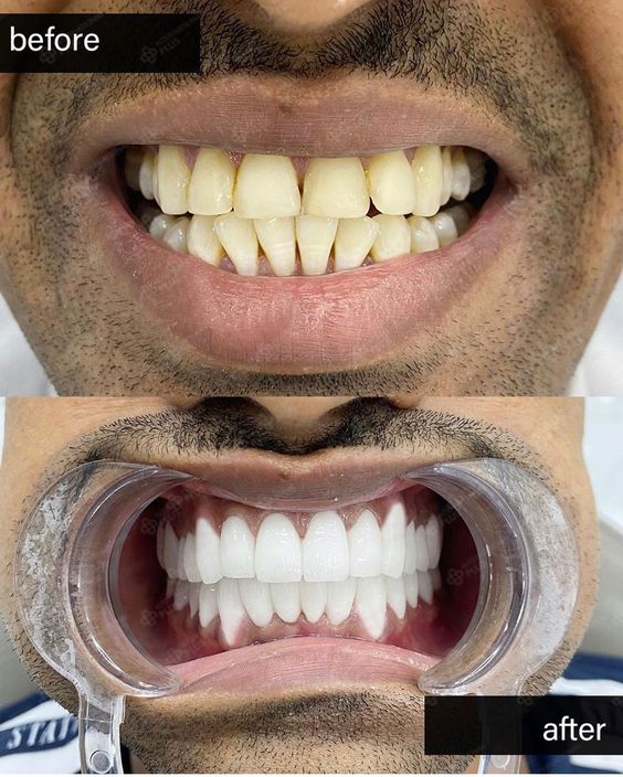 teeth whitening at dental lounge bahria town lahore
